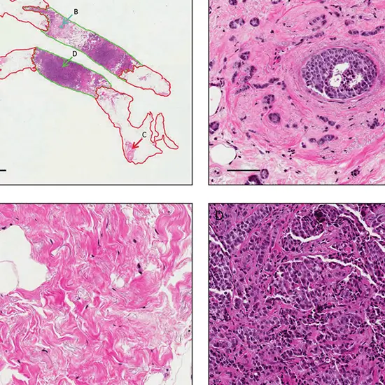Histopathology biopsy: second opinion test